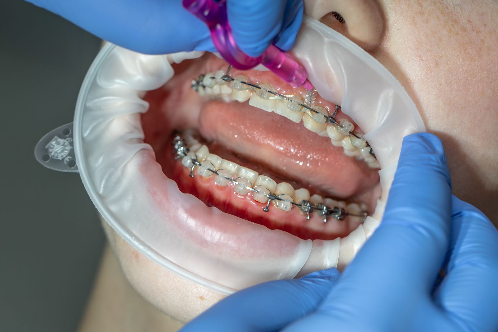 Ortodoncie a mléčné zuby 